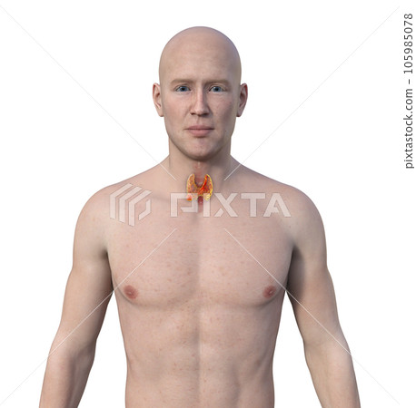 Thyroid cancer, 3D illustration Thyroid cancer, 3D illustration 105985078