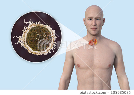 Thyroid cancer, 3D illustration Thyroid cancer, 3D illustration 105985085