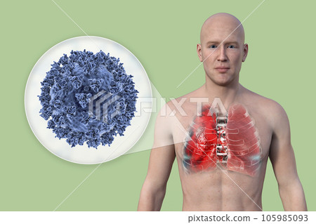 A 3D illustration showcasing the upper half part of a man with transparent skin, revealing the lungs affected by Covid-19 pneumonia A 3D illustration showcasing the upper half part of a man with transparent skin, revealing the lungs affected by Covid-19 pneumonia 105985093