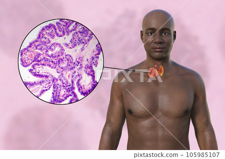 Thyroid cancer, 3D illustration Thyroid cancer, 3D illustration 105985107