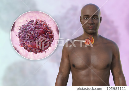 Thyroid cancer, 3D illustration Thyroid cancer, 3D illustration 105985111