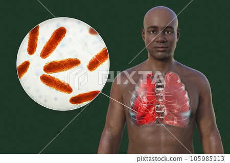 A 3D illustration showcasing the upper half part of a man with transparent skin, revealing the lungs affected by pneumonia A 3D illustration showcasing the upper half part of a man with transparent skin, revealing the lungs affected by pneumonia 105985113
