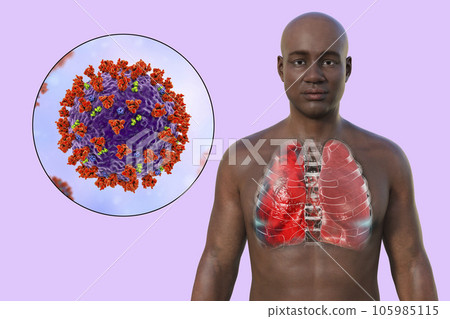 A 3D illustration showcasing the upper half part of a man with transparent skin, revealing the lungs affected by Covid-19 pneumonia A 3D illustration showcasing the upper half part of a man with transparent skin, revealing the lungs affected by Covid-19 pneumonia 105985115