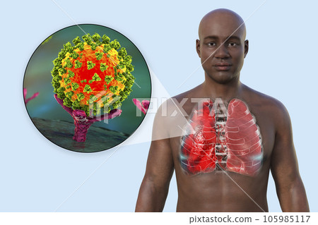 A 3D illustration showcasing the upper half part of a man with transparent skin, revealing the lungs affected by Covid-19 pneumonia A 3D illustration showcasing the upper half part of a man with transparent skin, revealing the lungs affected by Covid-19 pneumonia 105985117