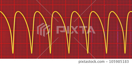 Electrocardiogram displaying ventricular tachycardia, 3D illustration 105985183