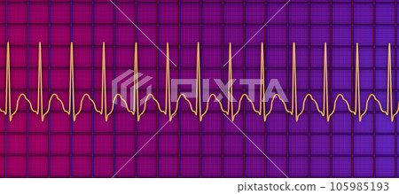 Electrocardiogram displaying supraventricular tachycardia, 3D illustration 105985193
