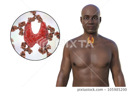 Autoimmune thyroiditis, conceptual illustration 105985200