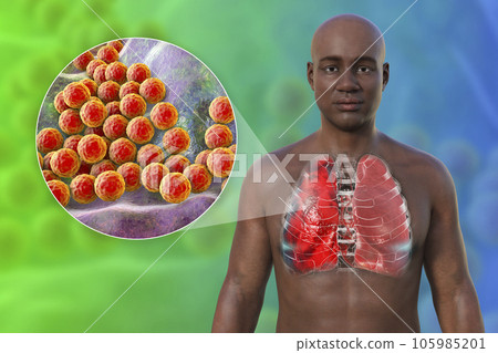 A 3D illustration showcasing the upper half part of a man with transparent skin, revealing the lungs affected by pneumonia 105985201