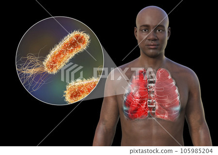 A 3D illustration showcasing the upper half part of a man with transparent skin, revealing the lungs affected by pneumonia A 3D illustration showcasing the upper half part of a man with transparent skin, revealing the lungs affected by pneumonia 105985204