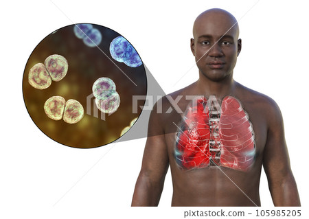 A 3D illustration showcasing the upper half part of a man with transparent skin, revealing the lungs affected by pneumonia 105985205