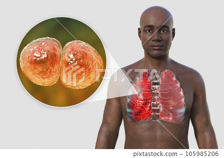 A 3D illustration showcasing the upper half part of a man with transparent skin, revealing the lungs affected by pneumonia 105985206