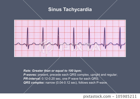 Electrocardiogram displaying sinus tachycardia, 3D illustration 105985211
