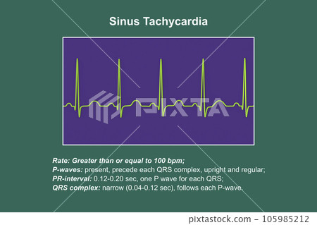 Electrocardiogram displaying sinus tachycardia, 3D illustration Electrocardiogram displaying sinus tachycardia, 3D illustration 105985212