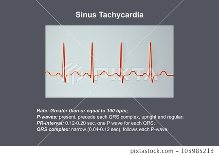 Electrocardiogram displaying sinus tachycardia, 3D illustration 105985213