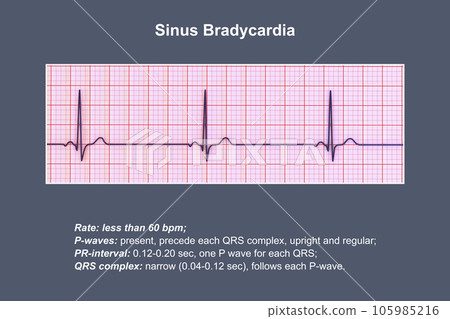 Electrocardiogram displaying sinus bradycardia, 3D illustration 105985216