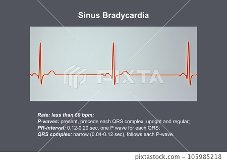 Electrocardiogram displaying sinus bradycardia, 3D illustration Electrocardiogram displaying sinus bradycardia, 3D illustration 105985218