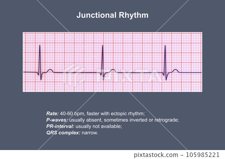 Electrocardiogram displaying a junctional rhythm, 3D illustration 105985221