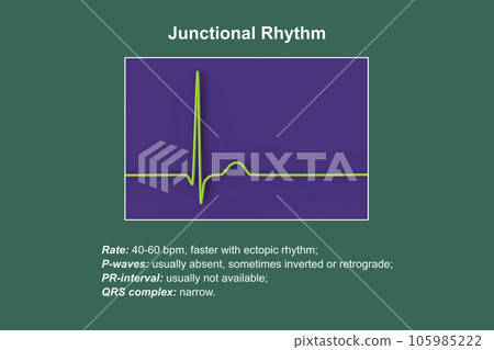 Electrocardiogram displaying a junctional rhythm, 3D illustration 105985222