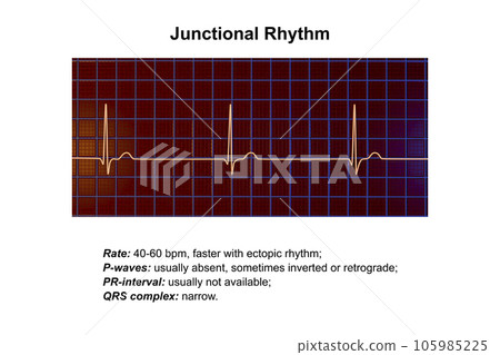 Electrocardiogram displaying a junctional rhythm, 3D illustration 105985225