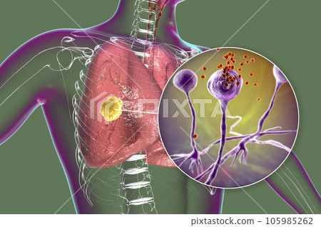 Lung mucormycosis lesion and close-up view of Rhizopus fungi, 3D illustration Lung mucormycosis lesion and close-up view of Rhizopus fungi, 3D illustration 105985262