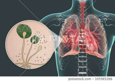 Lung mucormycosis lesion and close-up view of Rhizopus fungi, 3D illustration Lung mucormycosis lesion and close-up view of Rhizopus fungi, 3D illustration 105985266