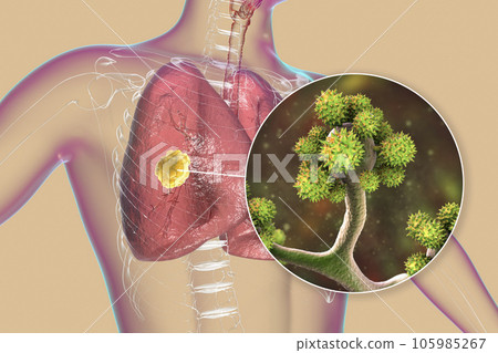 Lung mucormycosis lesion caused by Cunninghamella bertholletiae fungi, 3D illustration Lung mucormycosis lesion caused by Cunninghamella bertholletiae fungi, 3D illustration 105985267