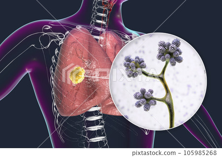 Lung mucormycosis lesion caused by Cunninghamella bertholletiae fungi, 3D illustration 105985268