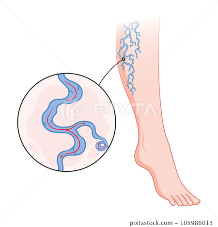 Varicose veins. Blue blood vessel visible through the skin, abnormally swollen leg. Vascular disease diagnostic and treatment. Venous insufficiency medical disease Varicose veins. Blue blood vessel visible through the skin, abnormally swollen leg. Vascular disease diagnostic and treatment. Venous insufficiency medical disease 105986013