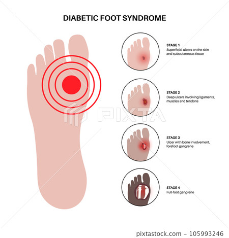Diabetic Foot Ulcers Diabetic Foot Ulcers 105993246