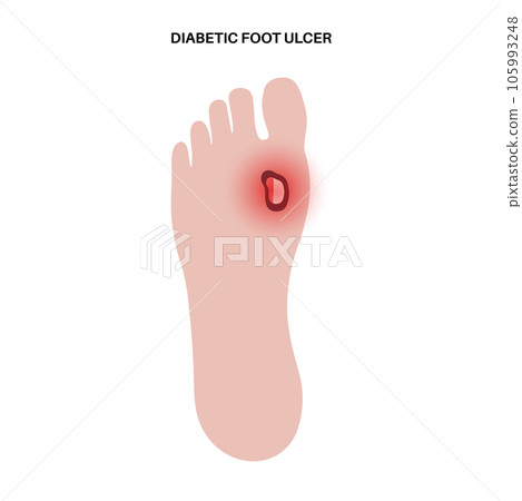 Diabetic Foot Ulcers 105993248