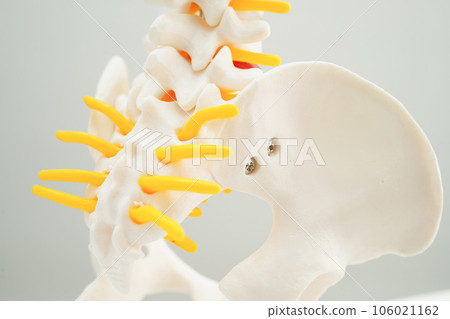 Spinal nerve and bone, Lumbar spine displaced herniated disc fragment, Model for treatment medical in the orthopedic department. Spinal nerve and bone, Lumbar spine displaced herniated disc fragment, Model for treatment medical in the orthopedic department. 106021162