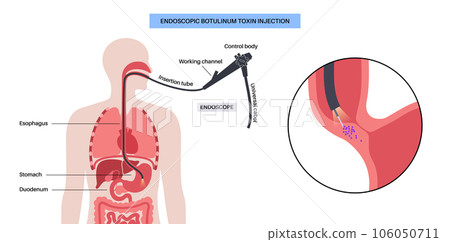 esophageal botulinum toxin injection 106050711