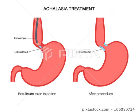 esophageal botulinum toxin injection esophageal botulinum toxin injection 106050724