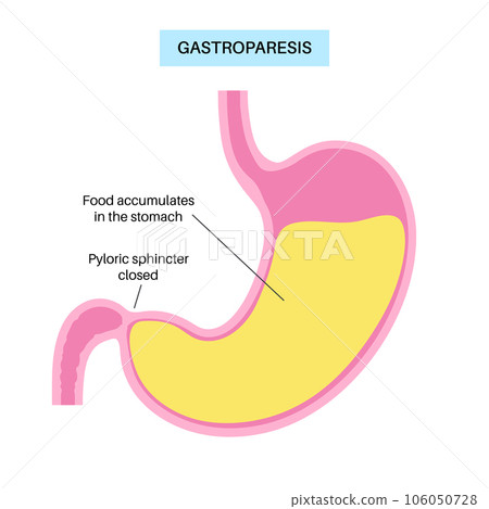 Gastroparesis anatomical poster 106050728