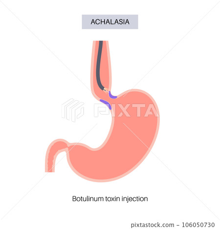 esophageal botulinum toxin injection 106050730