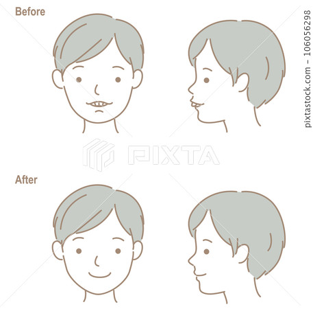 齙牙儿童的臉，正畸治療前後 106056298