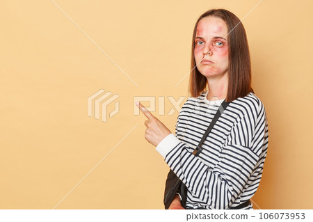 Despair woman with bruises and injuries wearing striped shirt standing isolated over beige background pointing at copy space advertising rehabilitation center for victims of violence 106073953