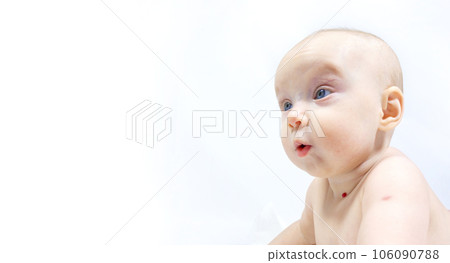 a baby with a hemangioma on his neck lies on a white background a baby with a hemangioma on his neck lies on a white background 106090788