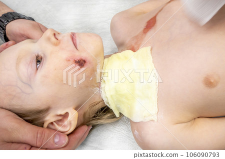 dressing a boy with a burn from boiling water 106090793