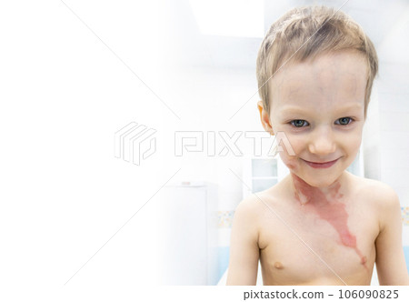dressing a boy with a burn from boiling water 106090825