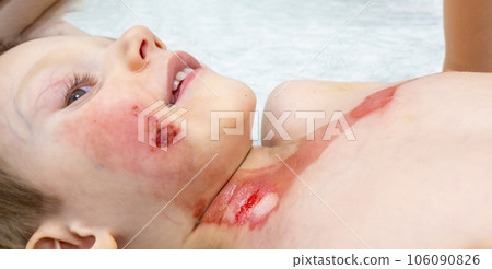 dressing a boy with a burn from boiling water 106090826