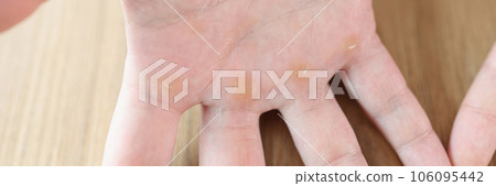 Calluses or corns on palmar surface of hand. Calluses or corns on palmar surface of hand. 106095442
