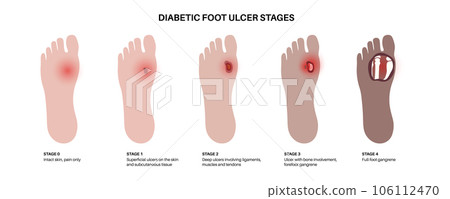Diabetic Foot Ulcers Diabetic Foot Ulcers 106112470