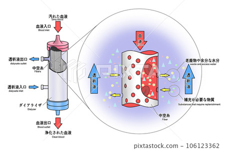 透析器的圖像說明-插圖素材 [106123362] - PIXTA圖庫