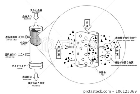 Image illustration of dialyzer 106123369