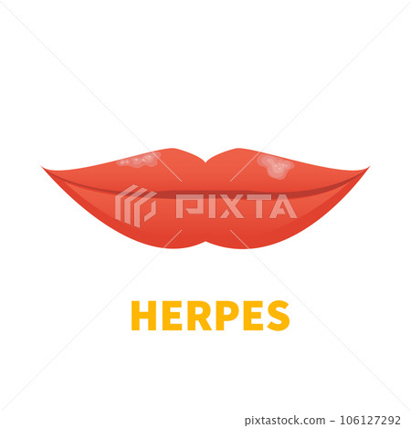 Herpes HSV cold sore lip outbreak medical icon 106127292