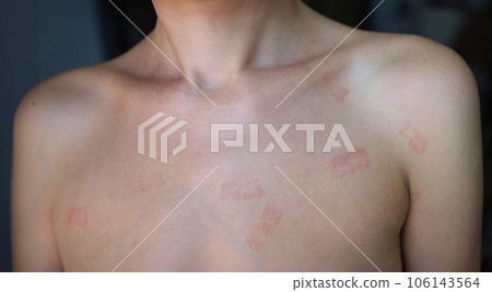 Red allergic spots rash on female body closeup 106143564