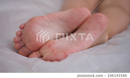 Eczema is an irritation caused by an allergic lesion of skin of feet in child Eczema is an irritation caused by an allergic lesion of skin of feet in child 106143566