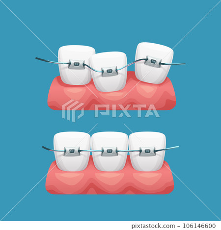 fixing teeth by dental braces on blue 106146600