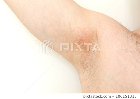 Allergy underarm. Cropped photo of irritation, inflammation on the sensitive skin after using a razor, trimmer, toxic deodorant or antiperspirant. Armpit rash. Atopic dermatitis. Acne or red spots. 106151313